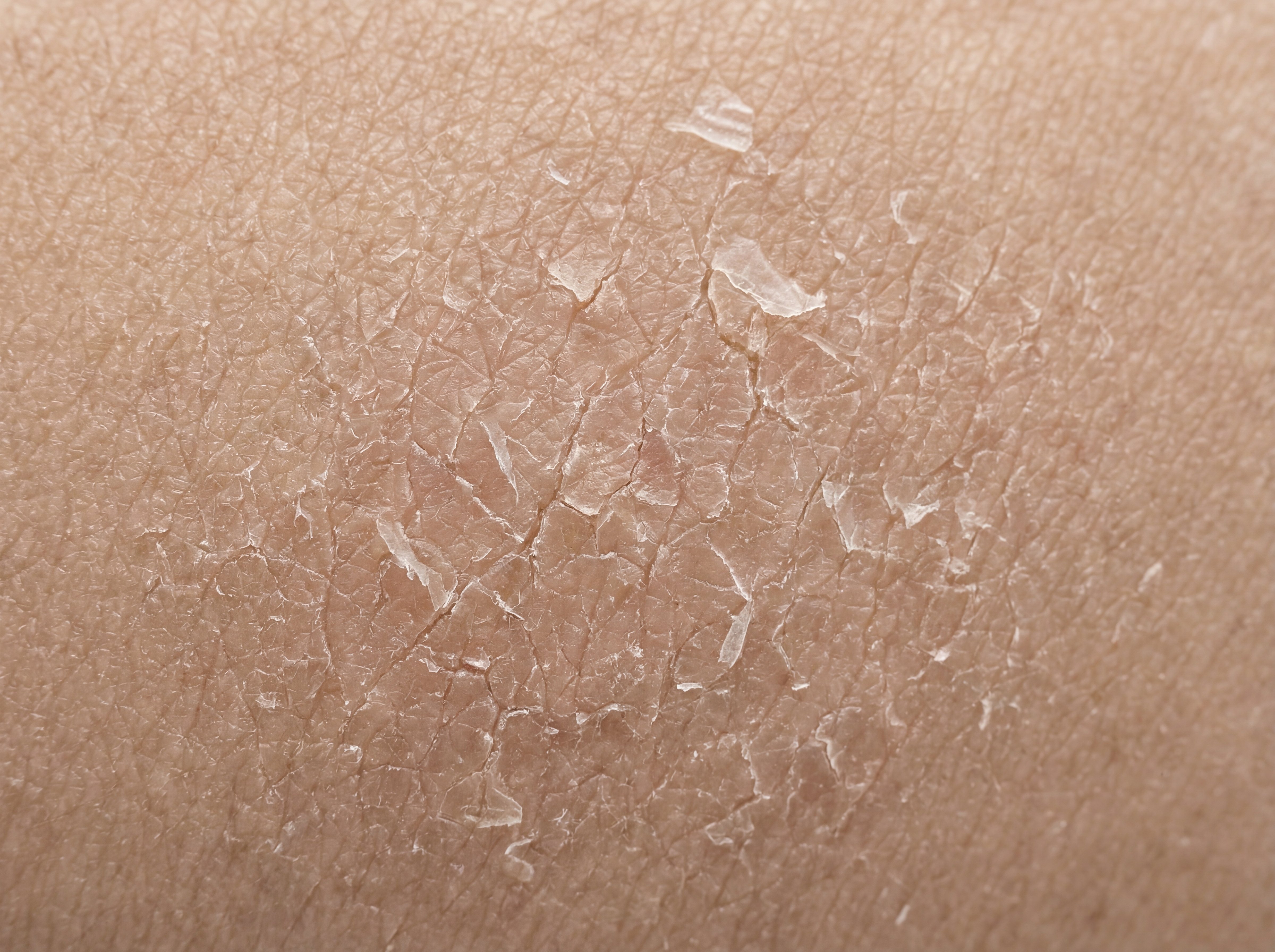 Extreme close-up macro photograph of dry flaking skin showing barrier damage with visible cracks and rough texture