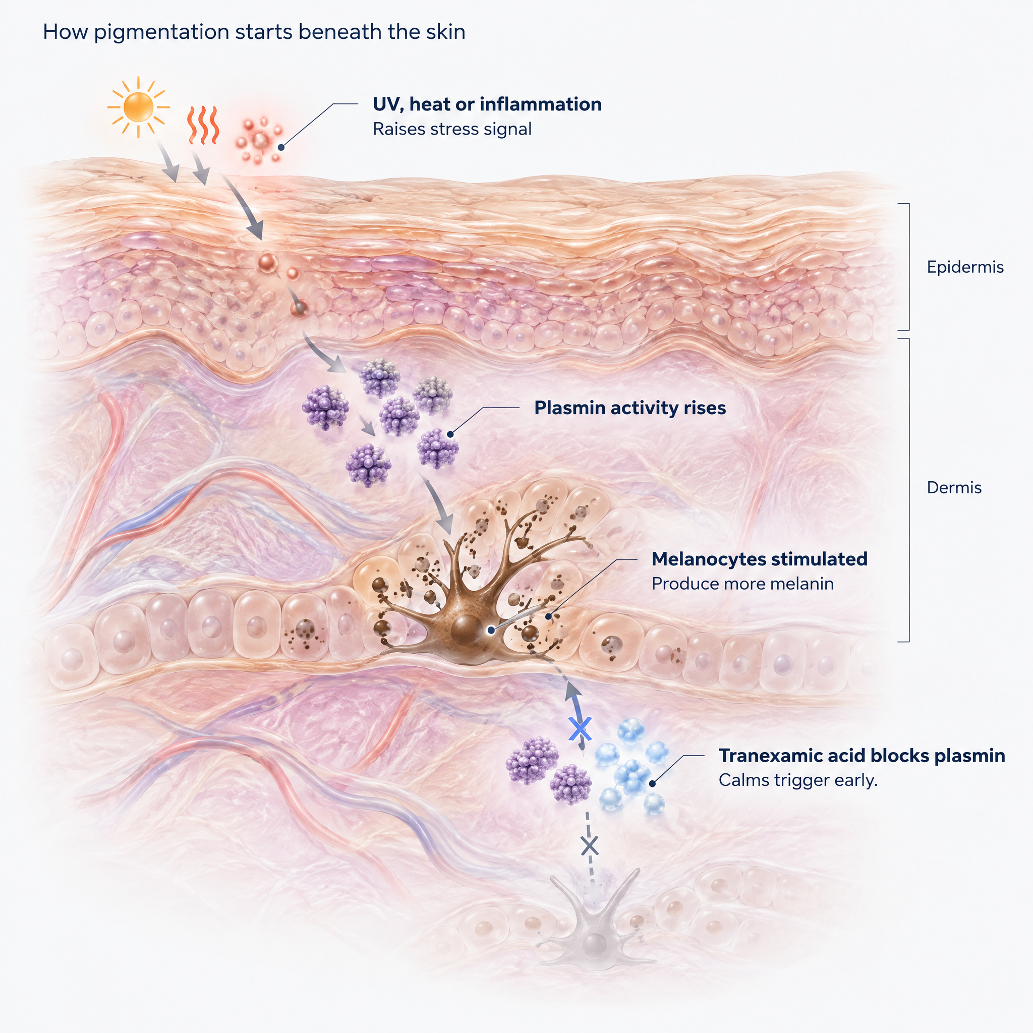 Diagram showing UV-triggered plasmin activating melanocytes, with tranexamic acid blocking the signal beneath the skin.