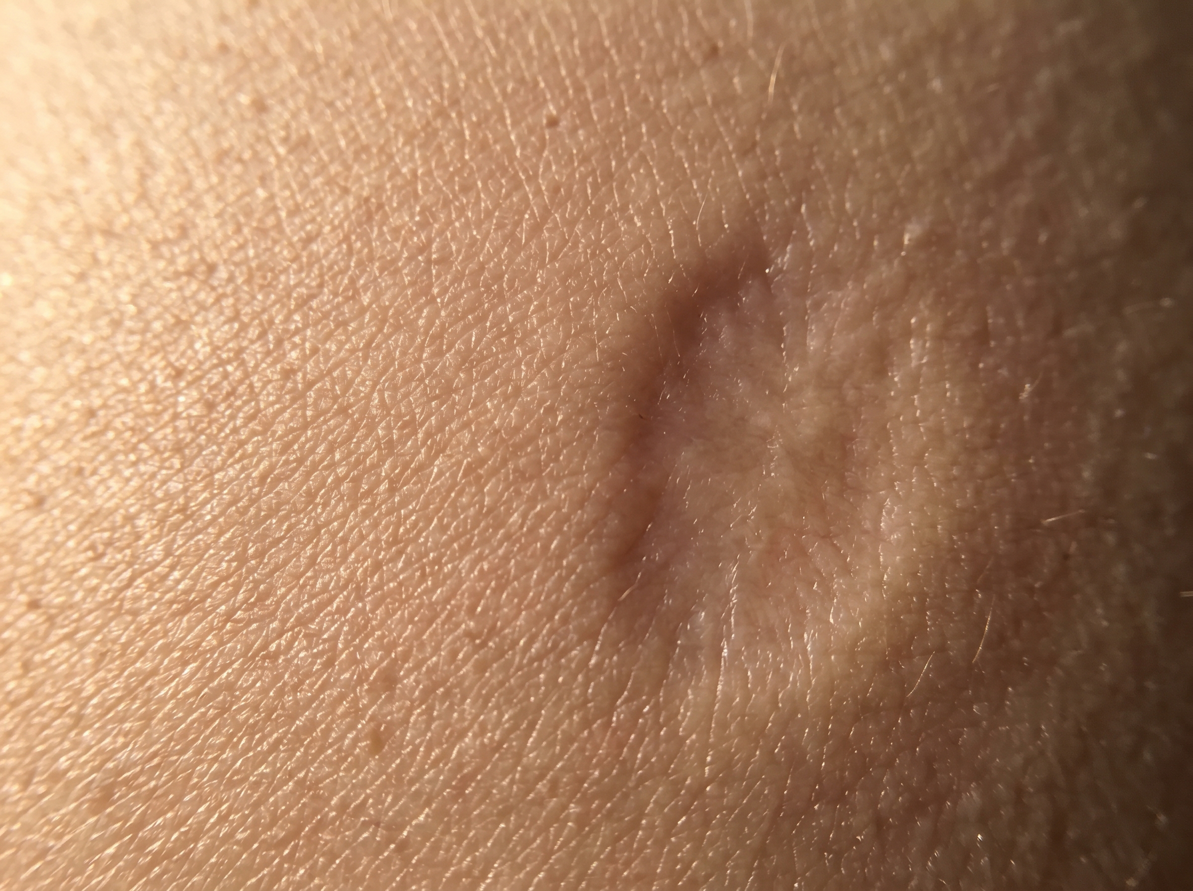 Extreme macro close-up of skin surface showing texture difference between smooth healed skin and a subtle depressed scar area in warm raking light