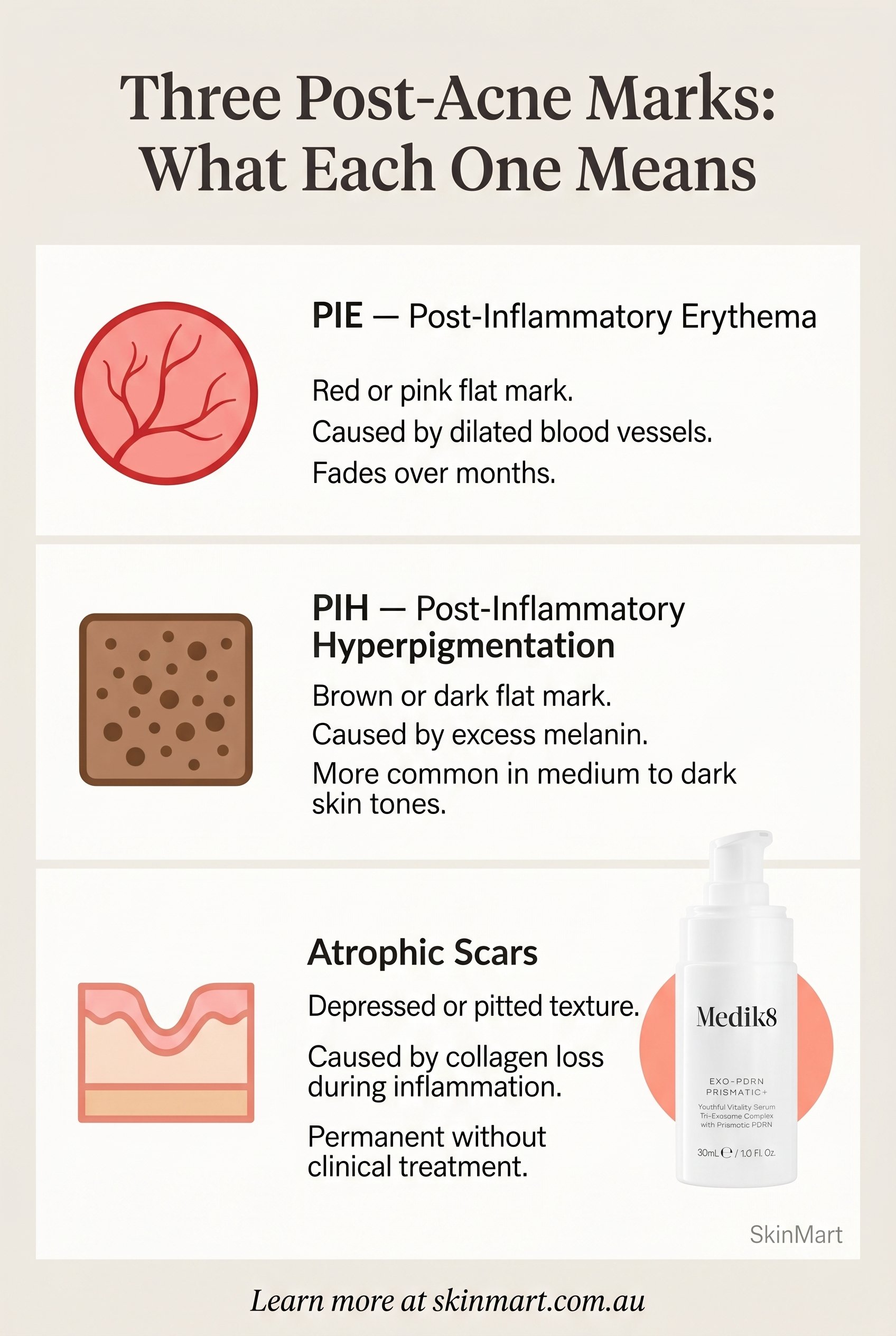Infographic comparing three types of post-acne marks: PIE shown as red vascular mark, PIH as dark flat pigmentation, and atrophic scars as depressed textural damage, with causes and outcomes listed for each