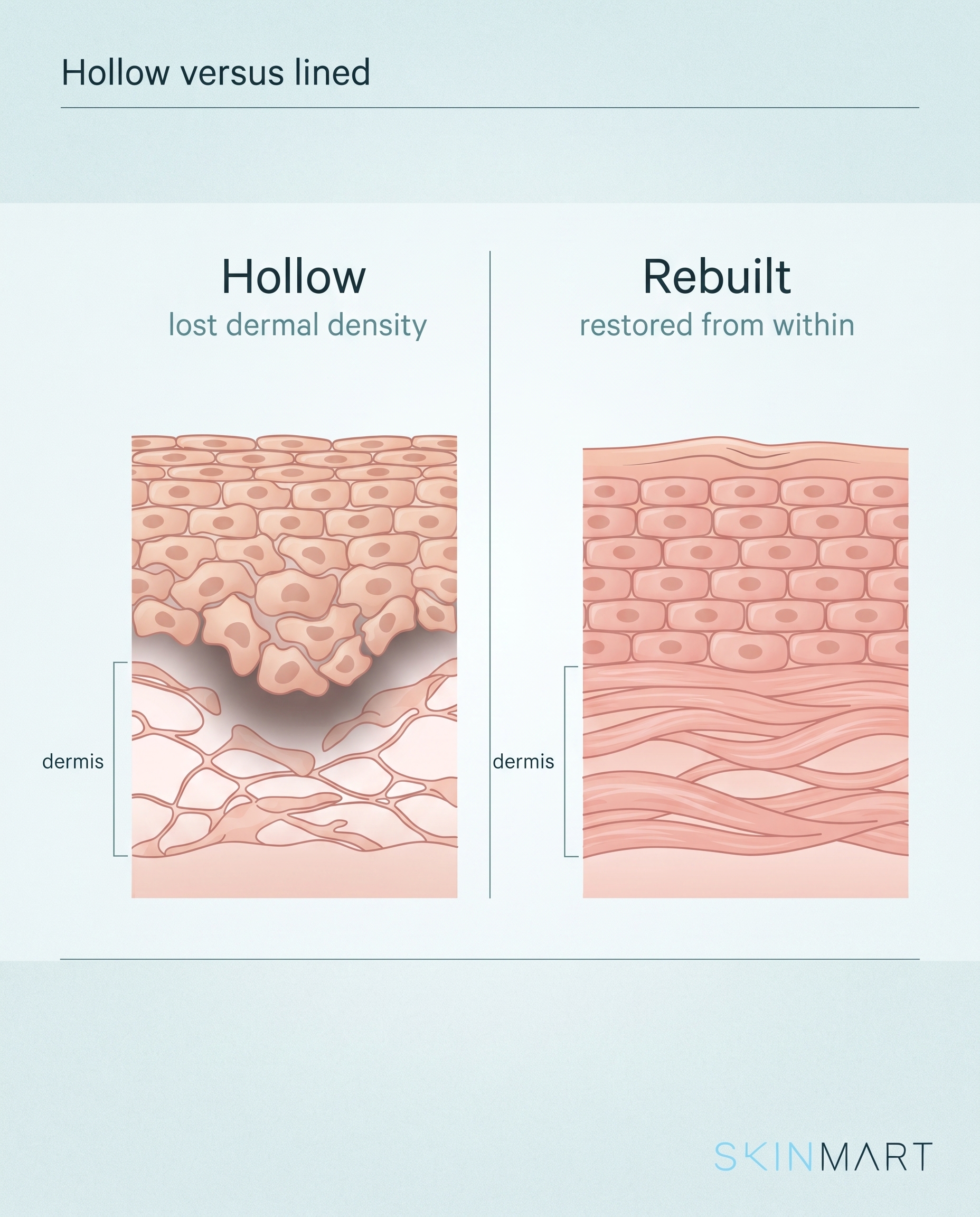 Cross-section diagram showing how under-eye hollowing from lost skin density creates shadows and lines